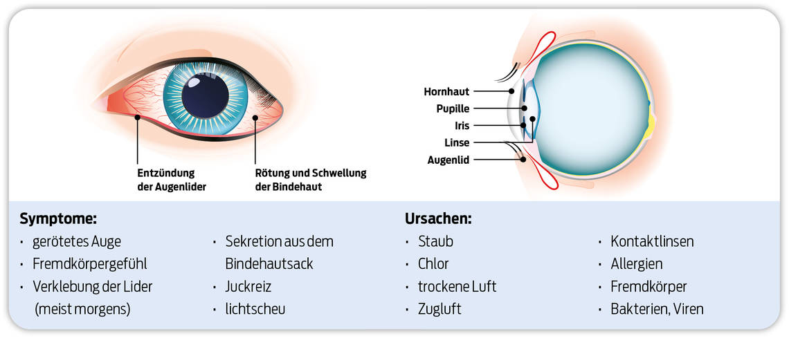 Entzündung der Augenlider. Rötung und Schwellung der Bindehaut.